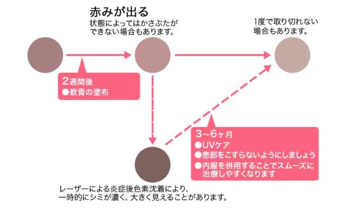 湘南美容クリニック　シミ取り